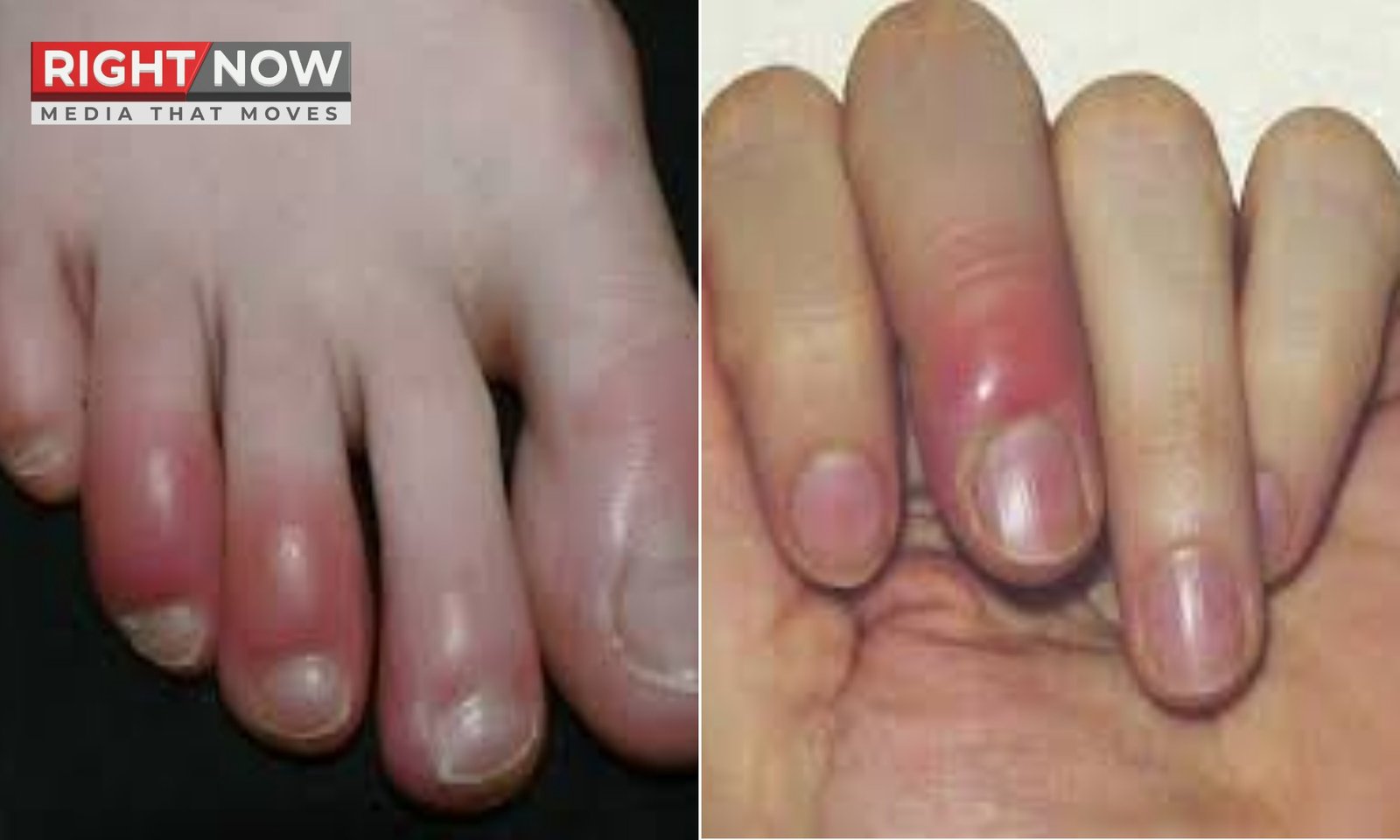 سردیوں میں ہاتھوں اور پیروں کی سوجن: اسباب اور حل