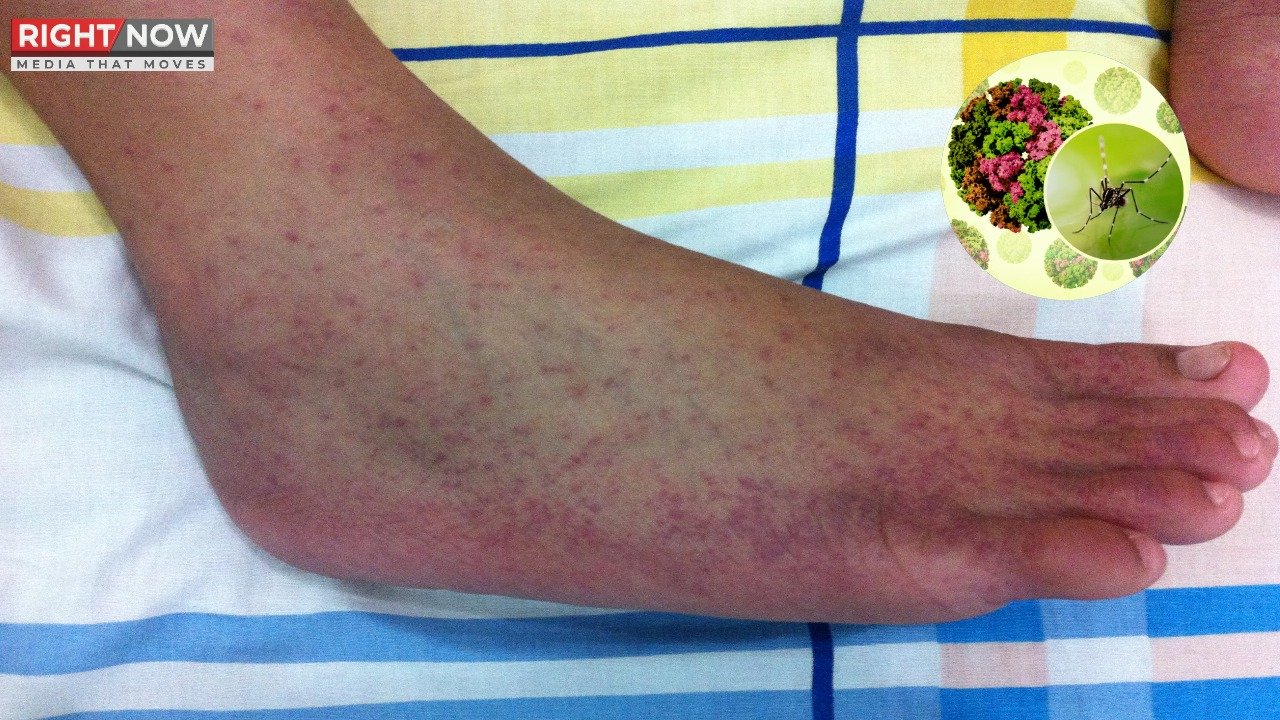 چکن گونیا کے کیسز میں تیزی، 186 افراد کی ہلاکت