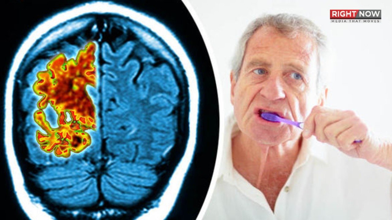 مسوڑھوں کی بیماری دماغی امراض کی شدت میں اضافہ کر سکتی ہے