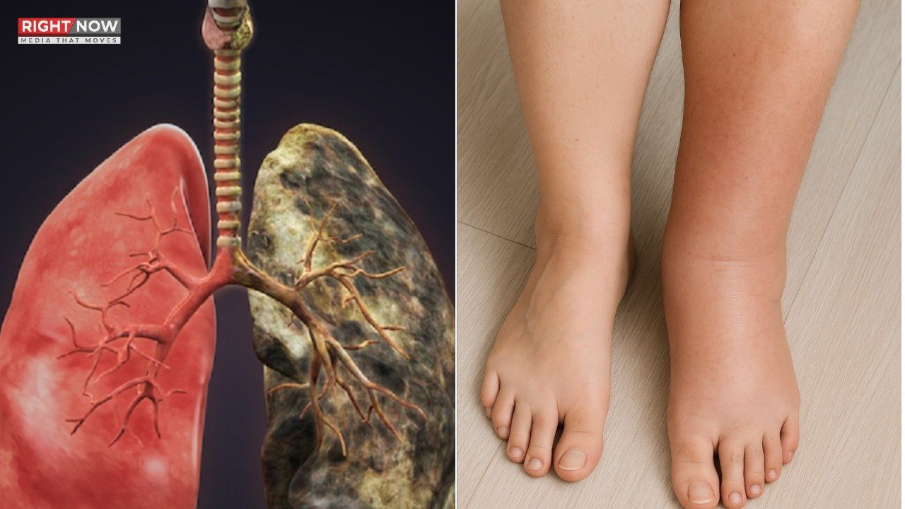 پھیپھڑوں کے کینسر کی علامات پیروں میں بھی ممکن، ماہرین کی تنبیہ