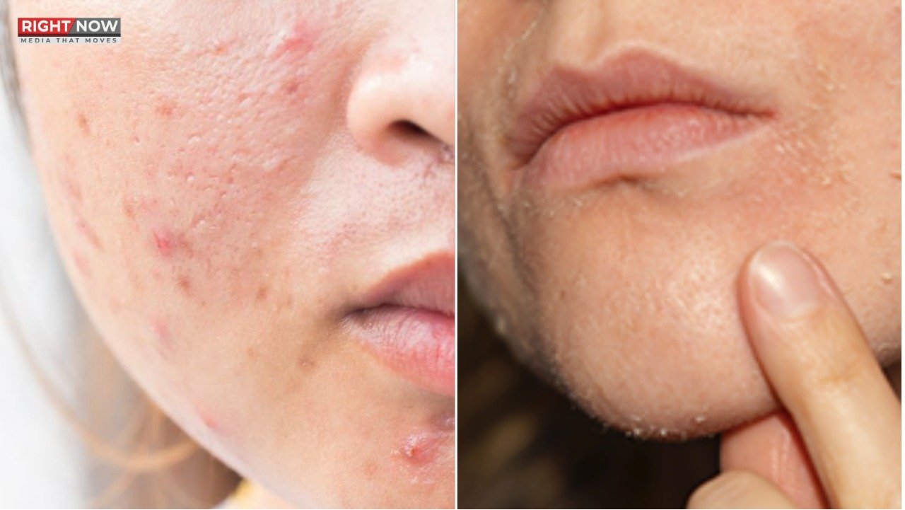 سردیوں میں کیل مہاسے بڑھنے کی وجوہات اور علاج