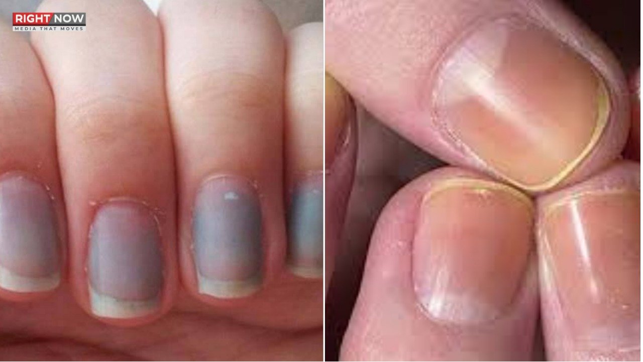 ناخنوں کے رنگ کی تبدیلی مختلف بیماریوں کی نشانی