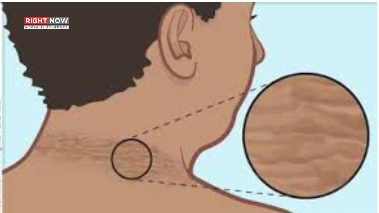 گردن پر سیاہ لکیریں صحت کے سنگین مسائل کی علامت