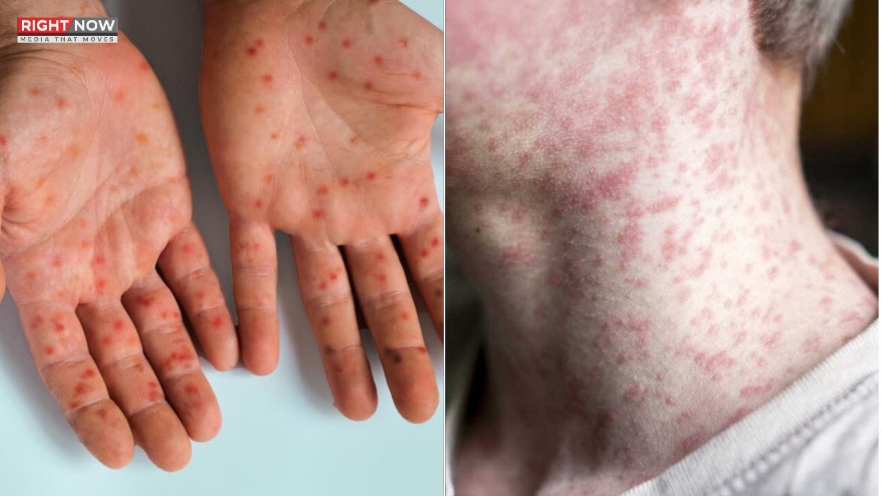 پنجاب میں خسرے کے کیسز میں خطرناک اضافہ