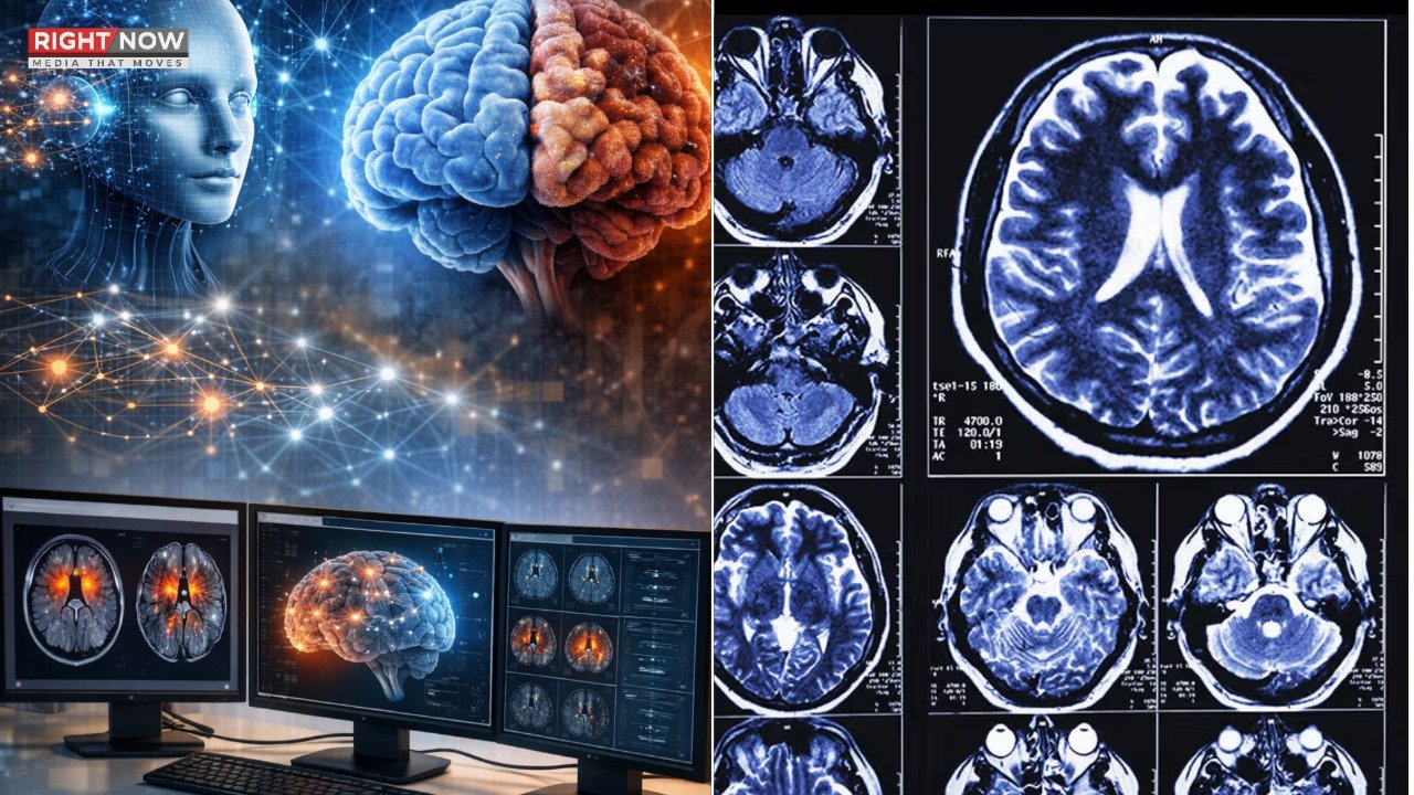 اے آئی کی مدد سے الزائمر کی درست پیشگی تشخیص ممکن