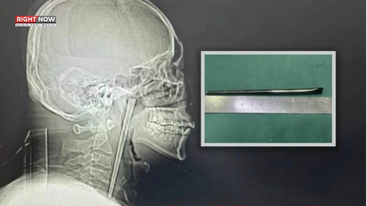چینی شخص نے 8 سال بعد حلق میں پھنسی چوپ اسٹک نکال لی