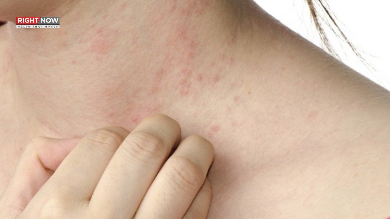 گرمی دانے، شدید گرمی میں بڑھنے کی وجوہات