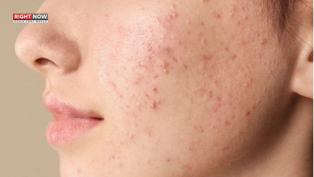 کیل مہاسوں کی وجہ روزمرہ عادات، ماہرین کی اہم تحقیق