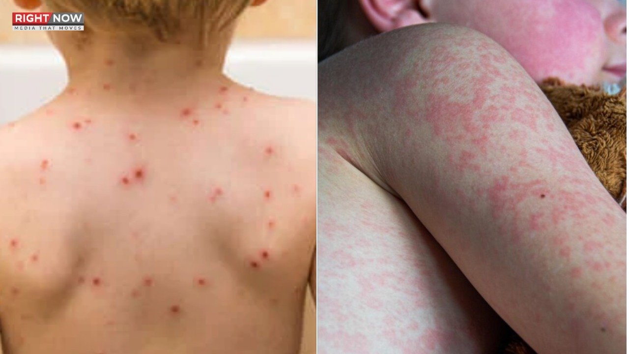 کراچی، بچوں میں خسرہ اور چکن پاکس کیسز میں اضافہ