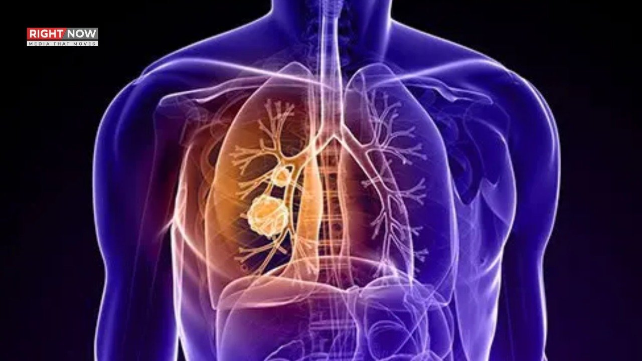 امریکا، تمباکو نوشی نہ کرنے والوں میں پھیپھڑوں کا کینسر بڑھنے کا انکشاف