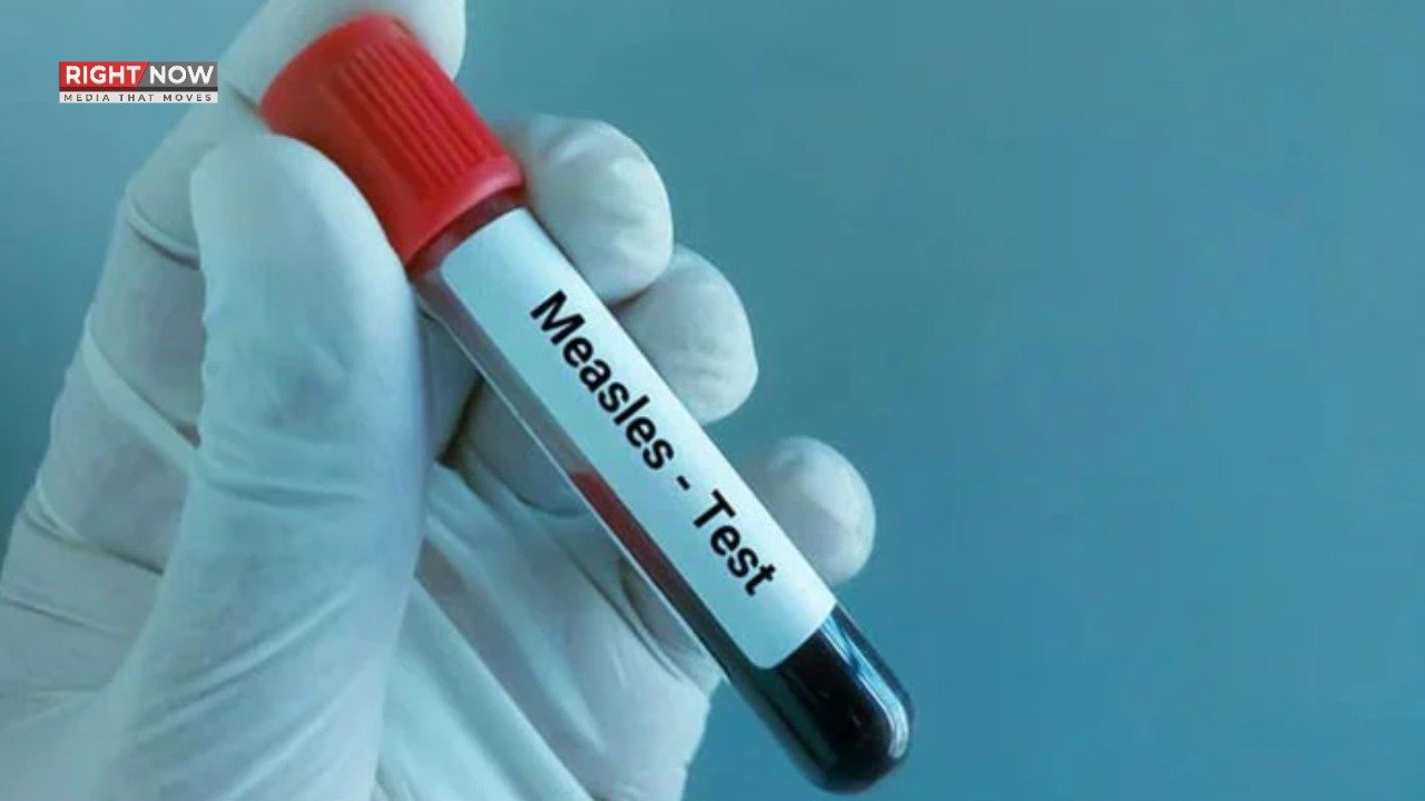 ملک بھر میں خسرے سے 71 اموات کی تصدیق