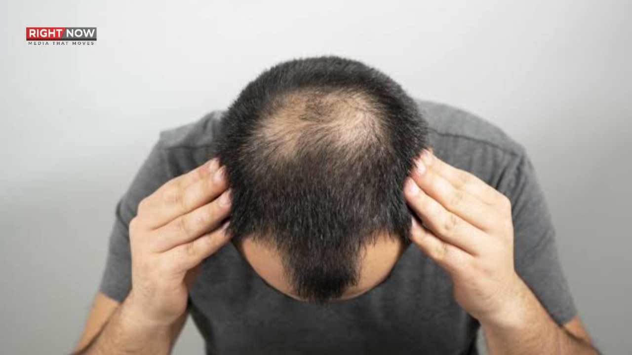 گنج پن کا مؤثر علاج دریافت، عالمی تحقیق میں بڑی پیشرفت