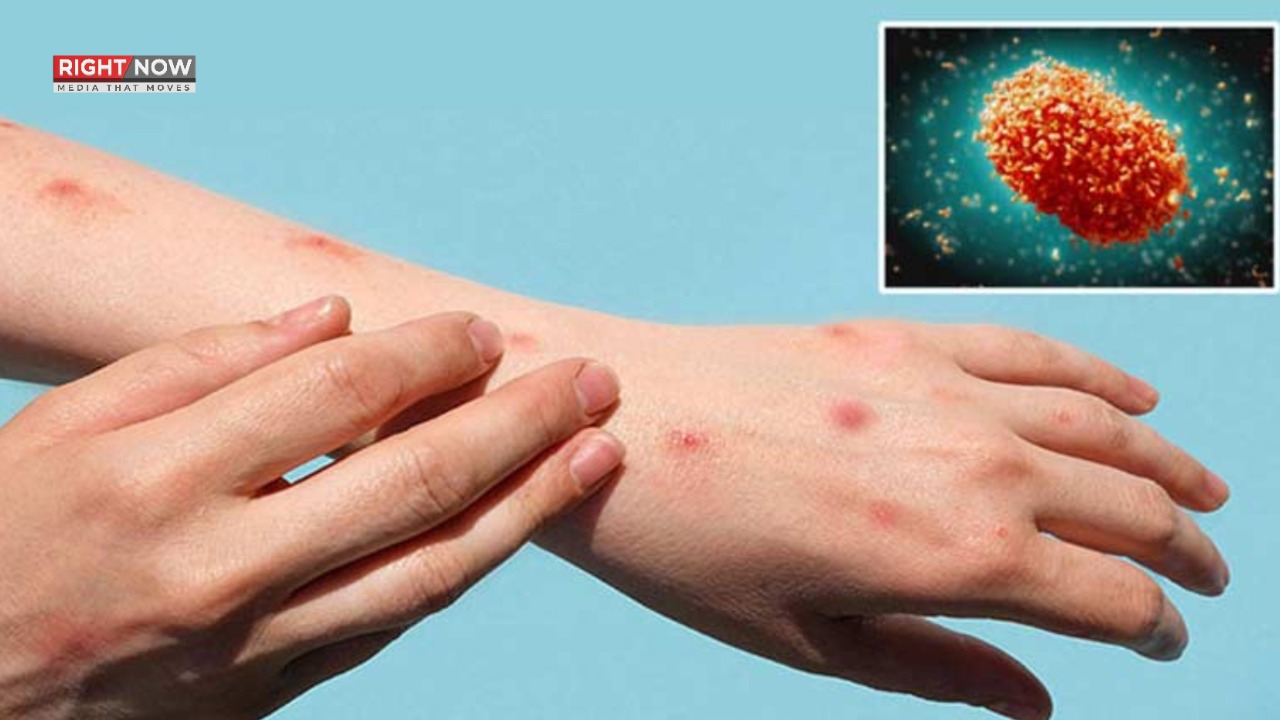سندھ میں ایم پاکس کے مزید 3 کیسز کی تصدیق، مجموعی تعداد 39 تک پہنچ گئی